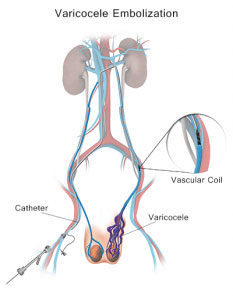 Varicocele Embolization Vascular coil Illustration