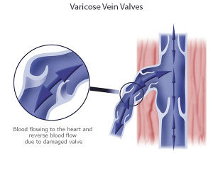Are Varicose Veins Hereditary?
