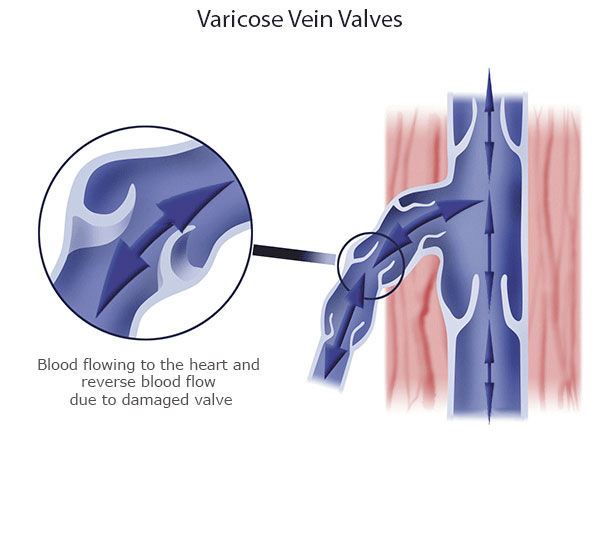 Varicose Viens and What Causes Them