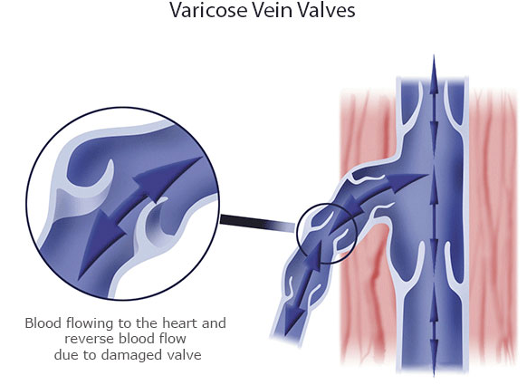 Image of Varicose Vein