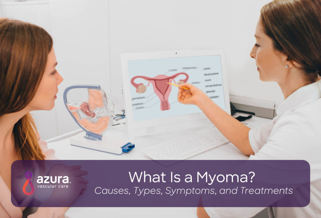 woman pointing at uterus poster with banner that reads, what is a myoma?"