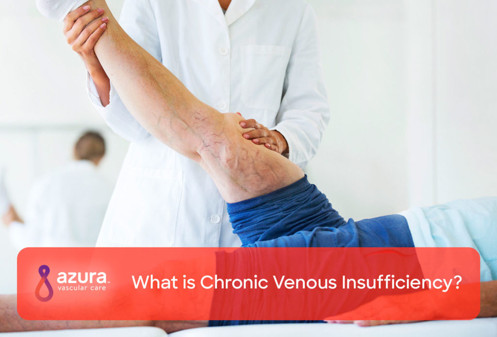 What is chronic venous insufficiency main image