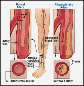 Cross Section Image of Artery in Normal and Altherosclerotic 