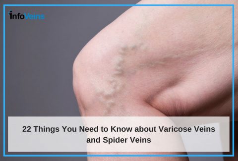 22 Things About Varicose Veins And Spider Veins That You May Not Be Aware Of