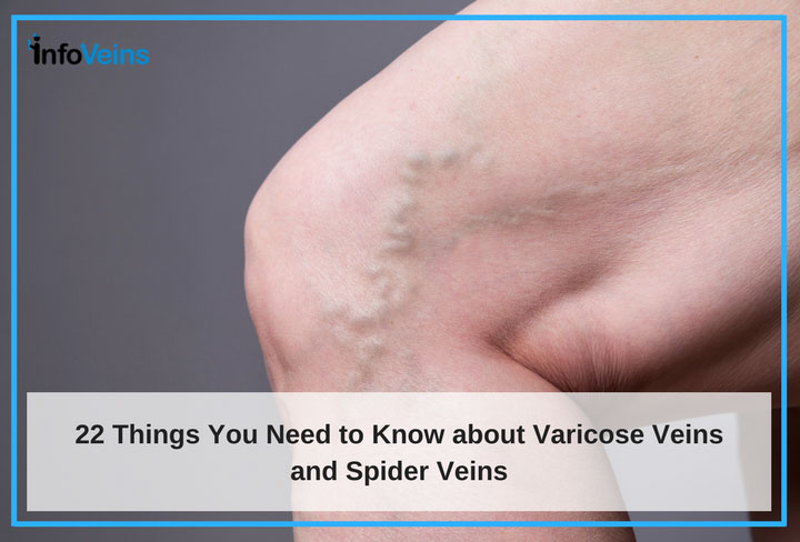 Varicose Veins: What You Need to Know - Preferred Vascular Group