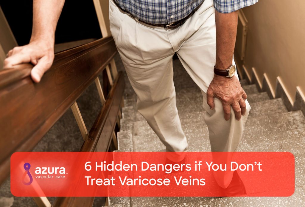 Why Painful Varicose Veins Should NOT Be Ignored