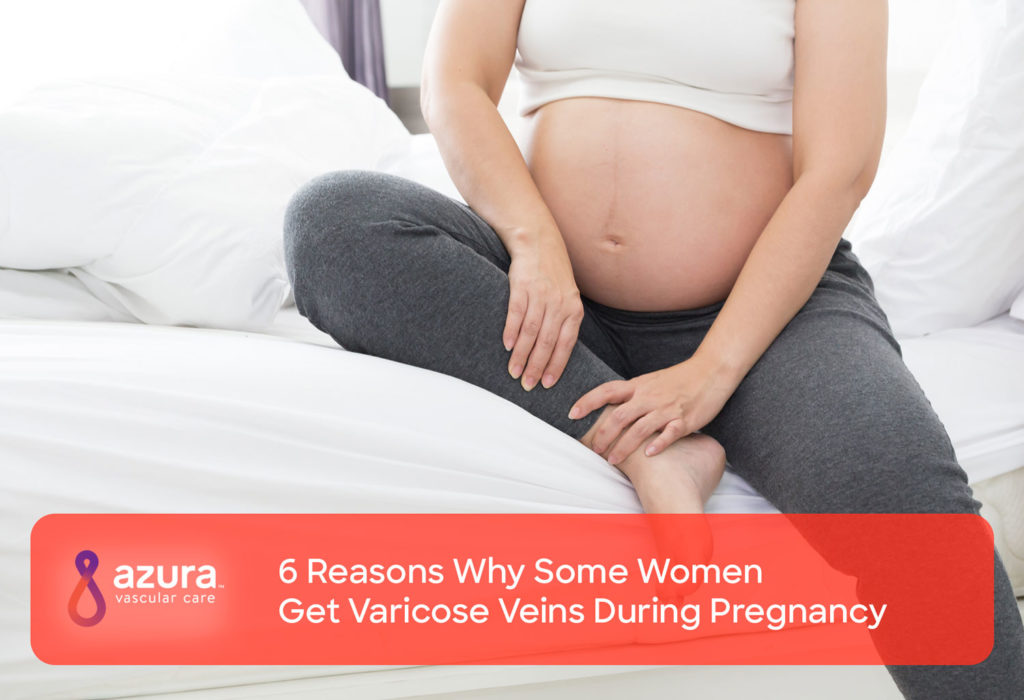 6 reasons why some women get varicose veins during pregnancy main image