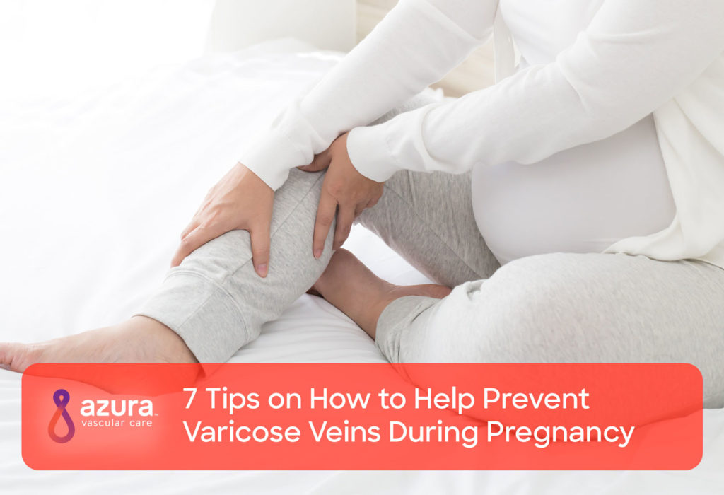 7 Tips on How to Help Prevent Varicose Veins During Pregnancy