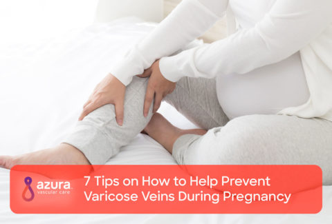 7 Tips on How to Help Prevent Varicose Veins During Pregnancy