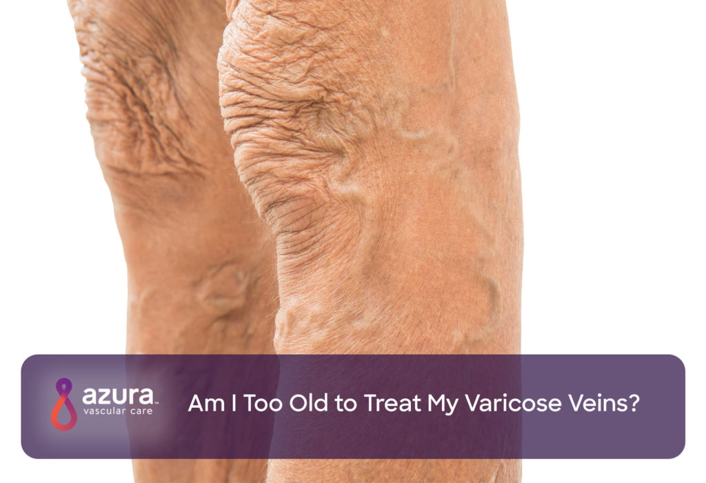 Am I Too Old to Treat My Varicose Veins?