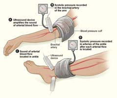 An_ankle-brachial_index_ABI_image