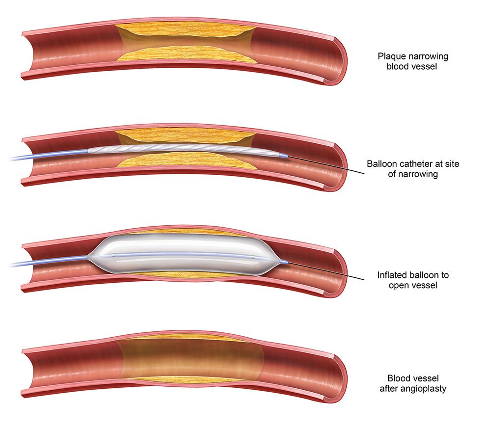 Angioplasty