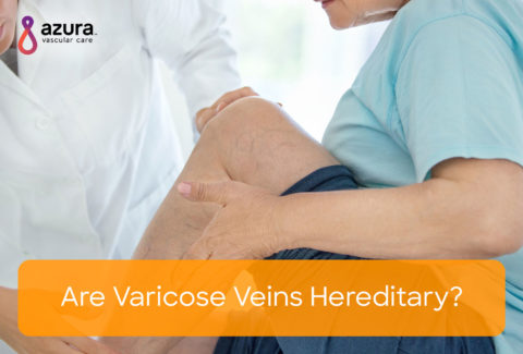 Are Varicose Veins Hereditary?