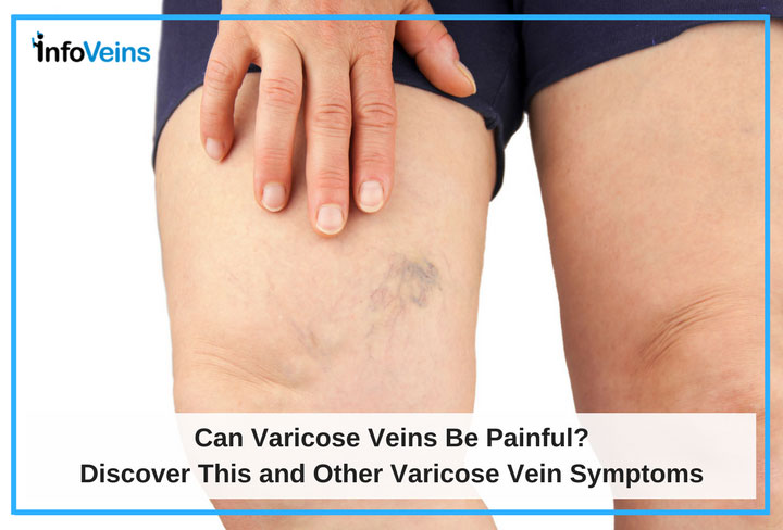 The Causes and Treatment of Varicose Veins