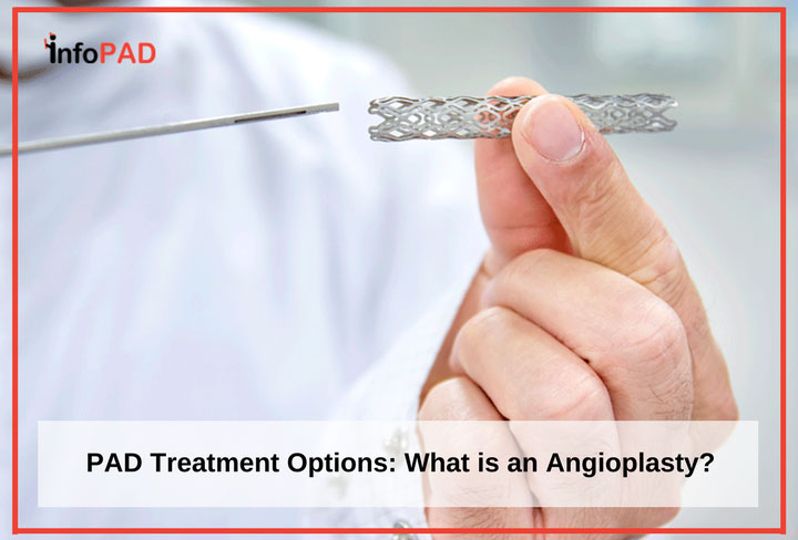PAD Treatment Options - What is an Angioplasty Feature Image