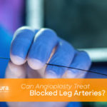Can Angioplasty Treat Blocked Leg Arteries main image