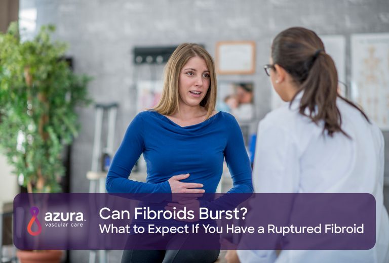 What to Expect If You Have a Ruptured or Burst Fibroid