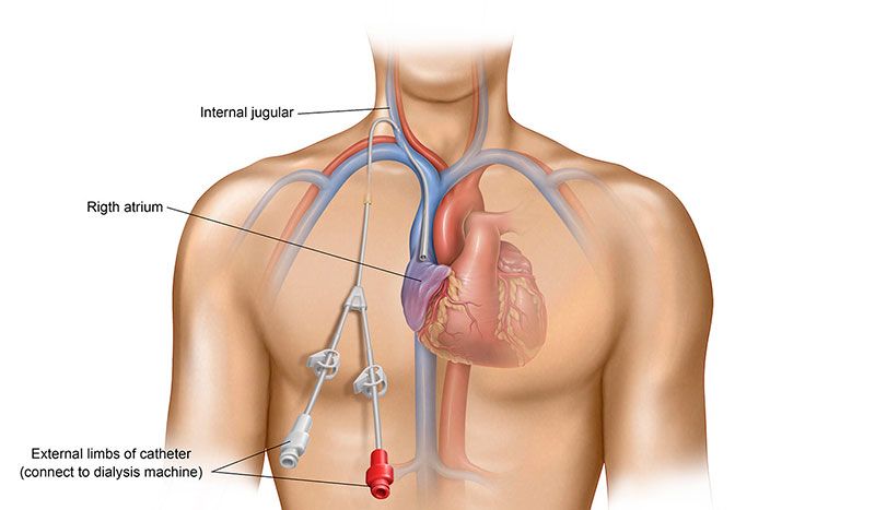 Central-venous-catheter