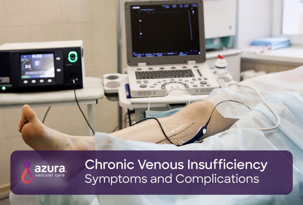 Chronic Venous Insufficiency Symptoms and Complications main image