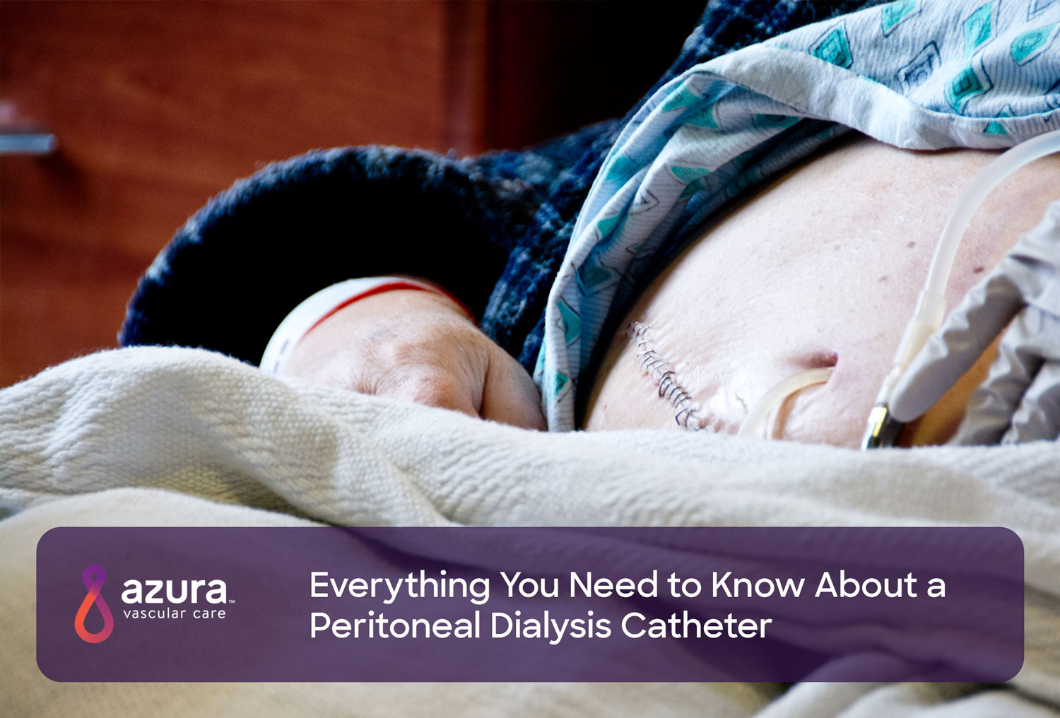 Understand the Peritoneal Dialysis Catheter