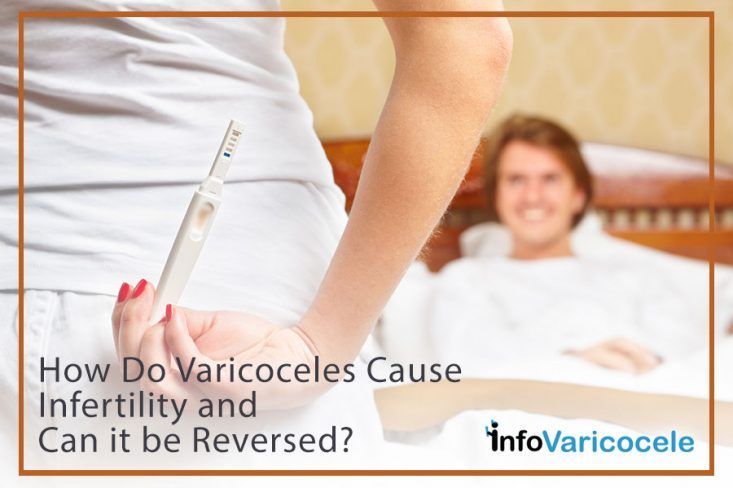 How to Treat Varicose Veins Without Surgery?