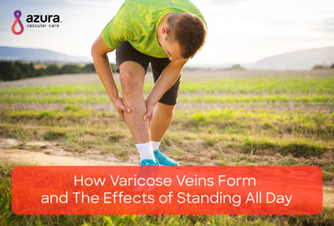 How Varicose Veins Form and the Effects of Standing All Day