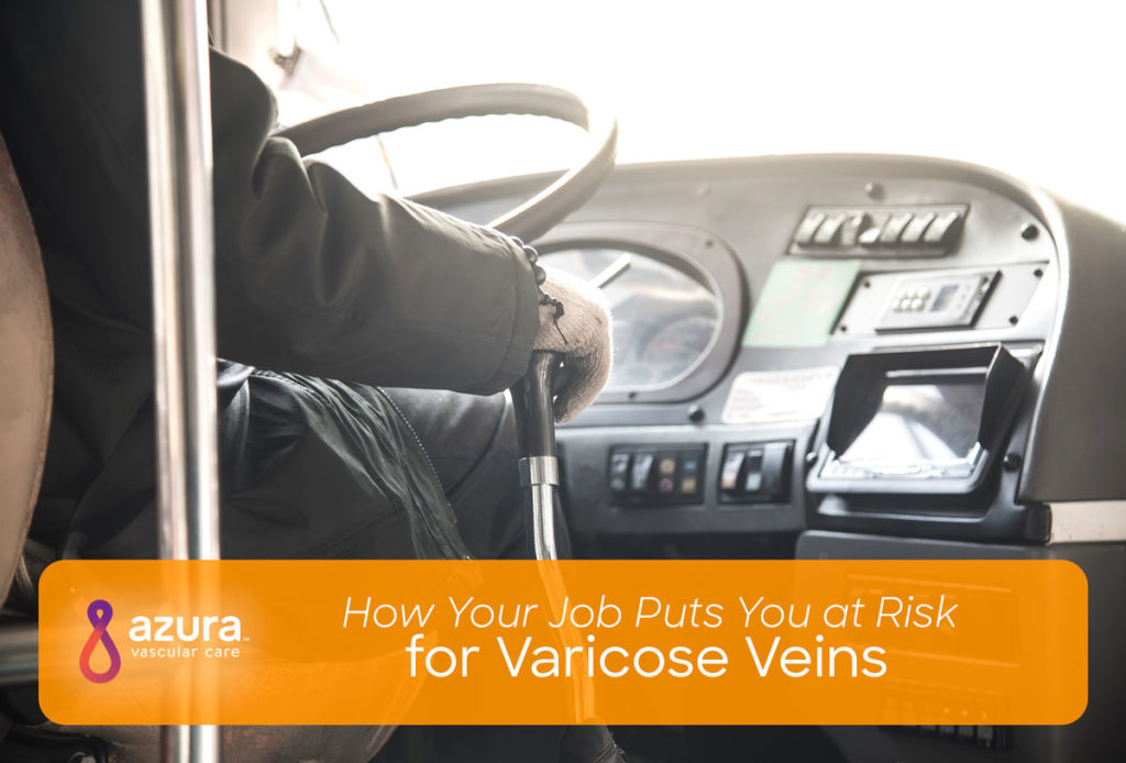 How Your Job Puts You at Risk for Varicose Veins