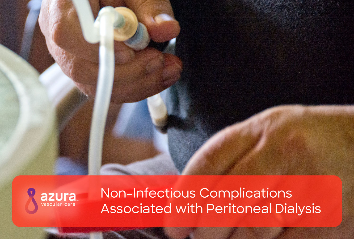 NonInfectious Complications Associated with Peritoneal Dialysis