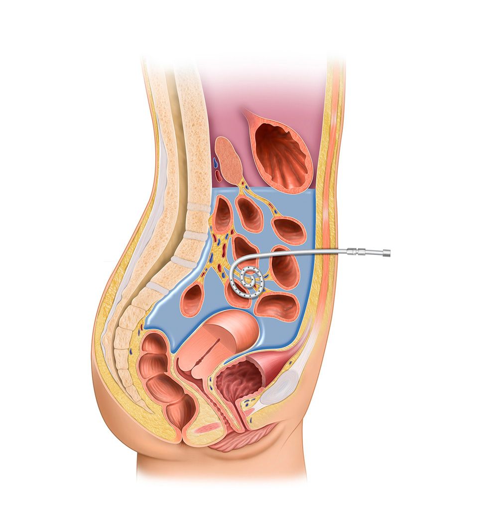 Peritoneal Dialysis Cycle3