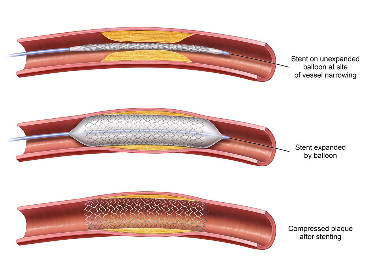 Stenting