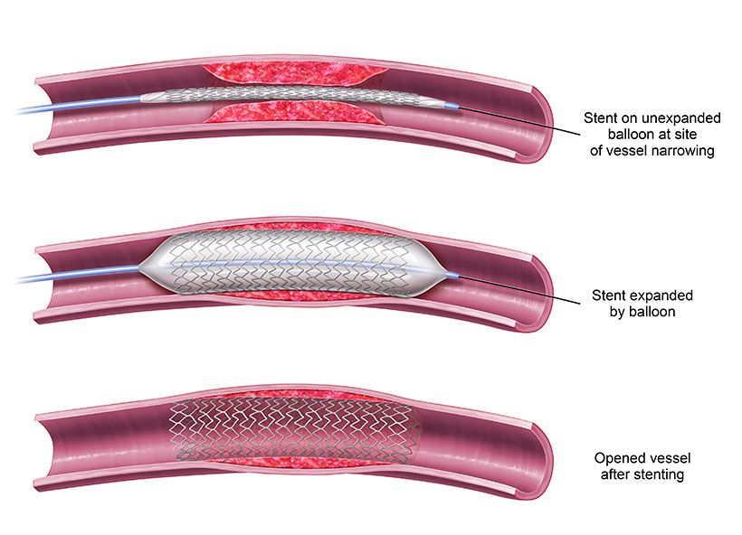 Stenting Thrombus