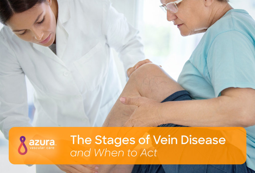 The stages of vein disease and when to act main image