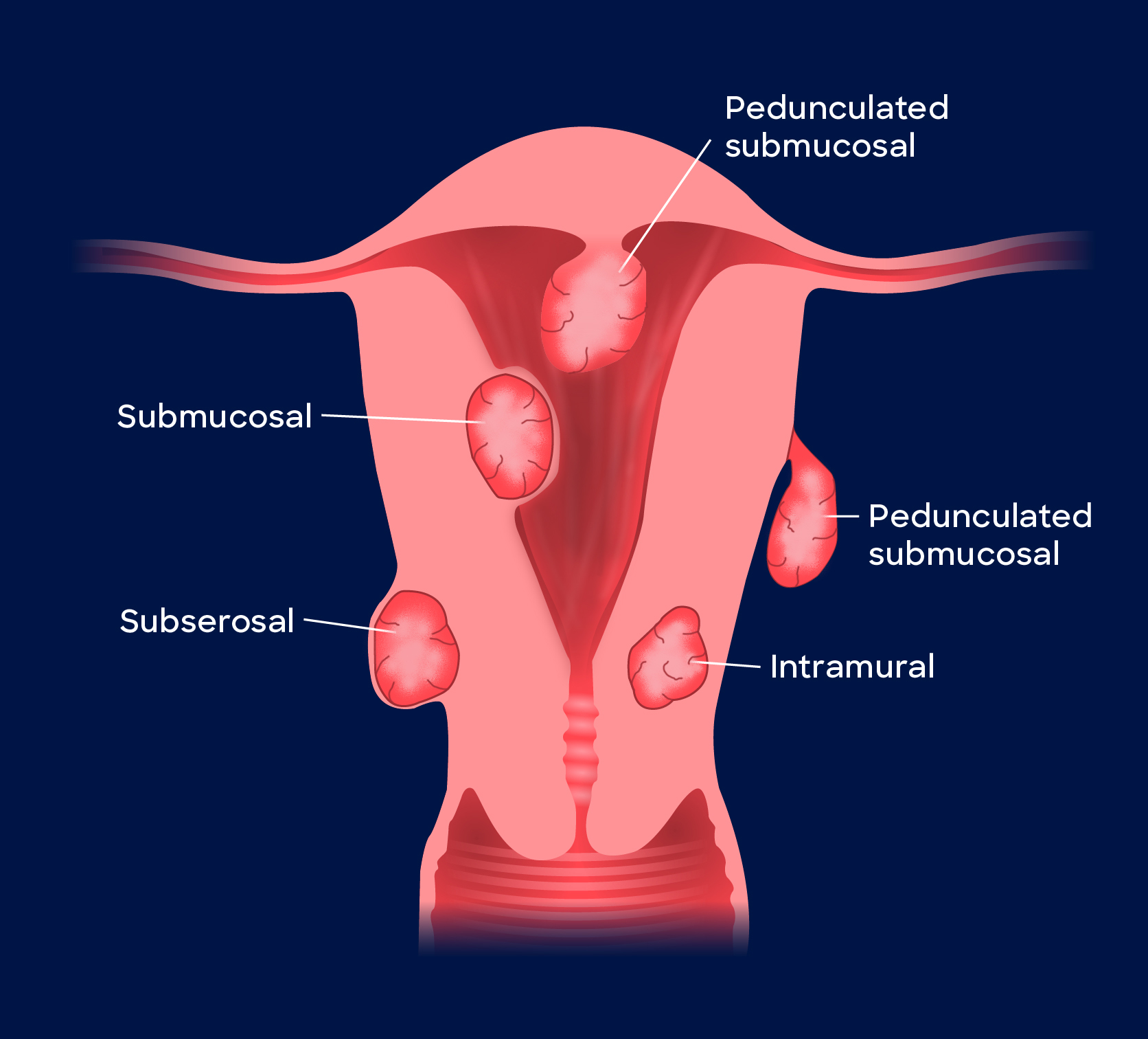 Uterine Fibroid Embolization