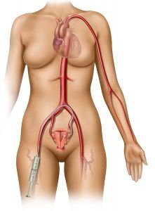 Uterine Fibroid Embolization Femoral