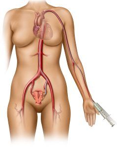 Uterine Fibroid Embolization Transradial