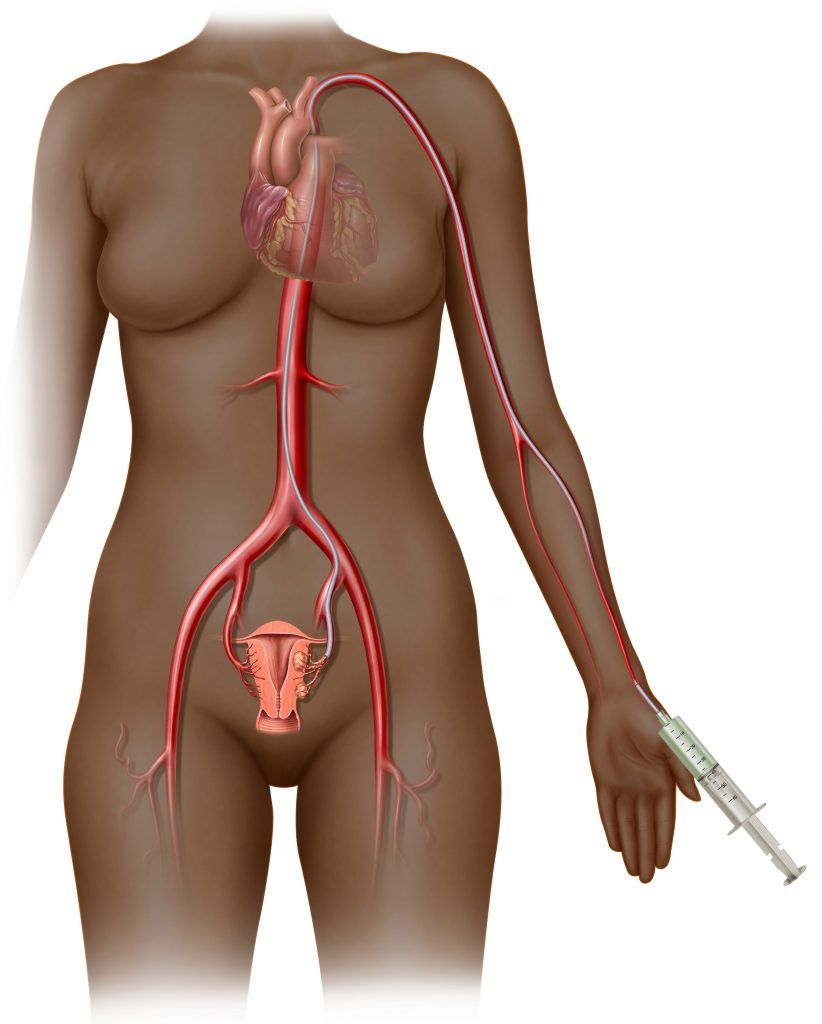 Uterine Fibroid Embolization Transradial AfAm