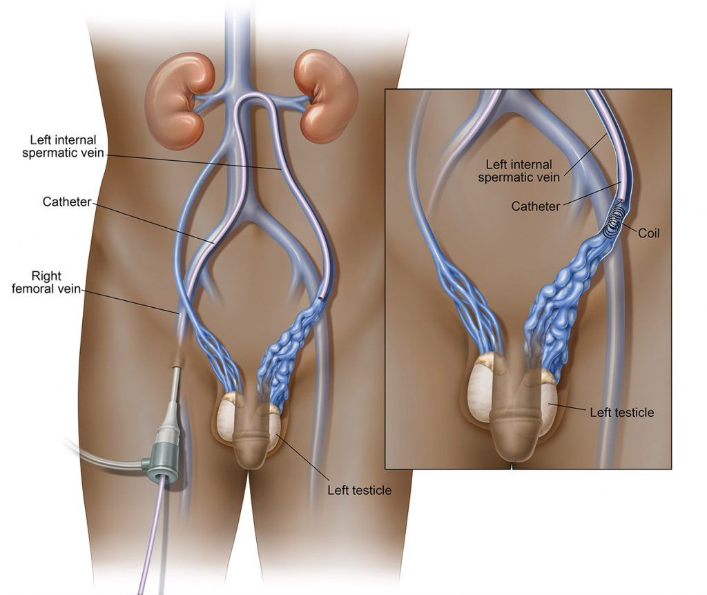 Varicocele Embolization