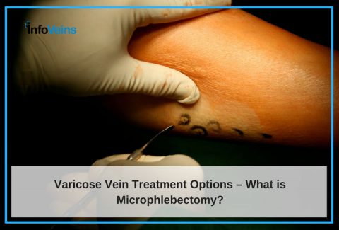 Varicose Vein Treatment Options – What Is Microphlebectomy?