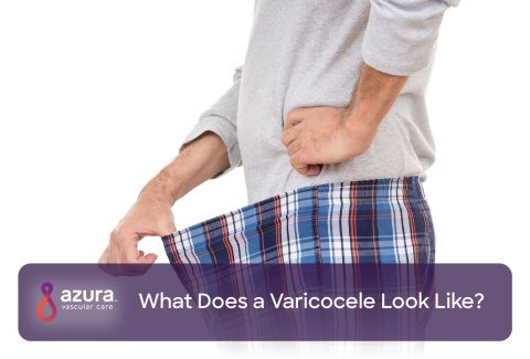 What Does a Varicocele Look Like? main image