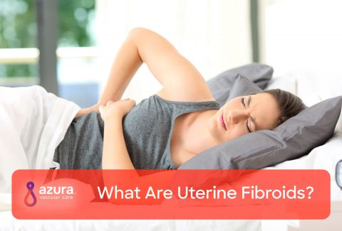 What Are Uterine Fibroids?