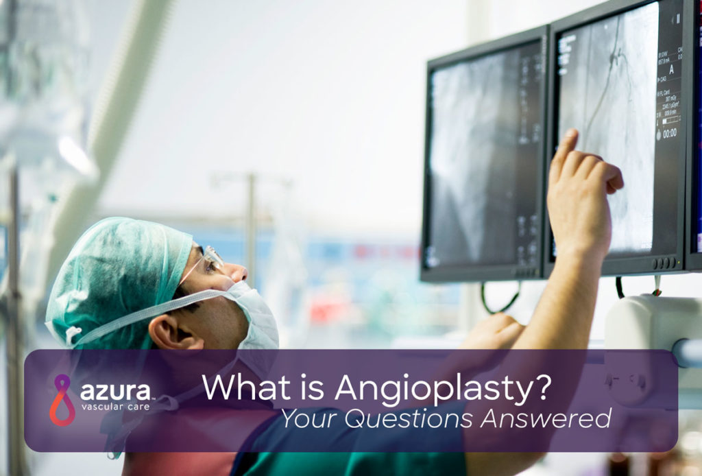 What is Angioplasty Your Questions Answered