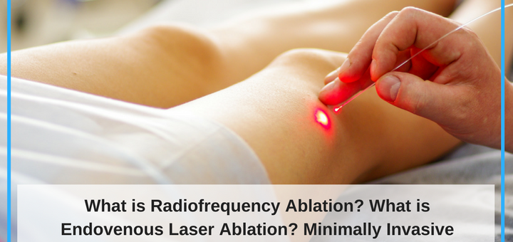What Is Radiofrequency Ablation and Endovenous Laser Ablation? Other Treatment Options For Varicose Vein