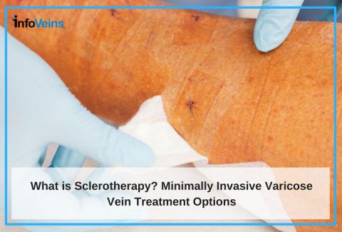 What Is Sclerotherapy? Minimally Invasive Varicose Veins Treatment Options