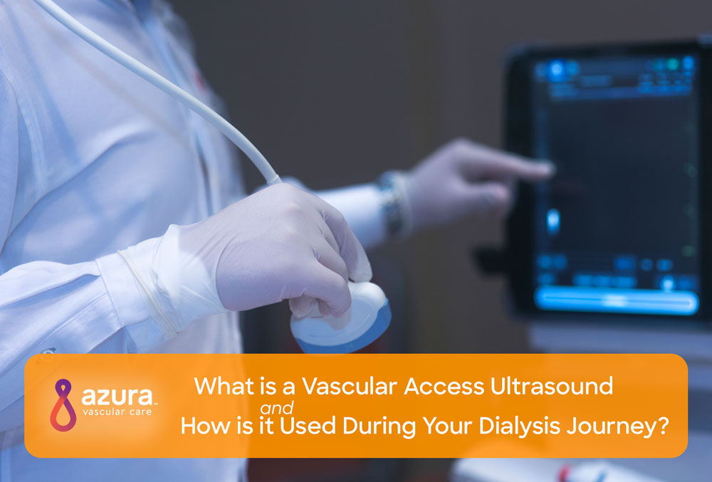 Doppler vascular mapping in Arterio Venous Fistula (AVF)