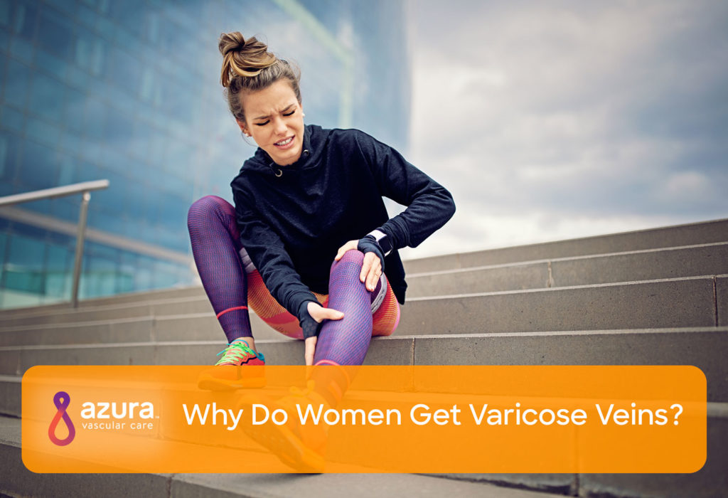 why do women get varicose veins main image
