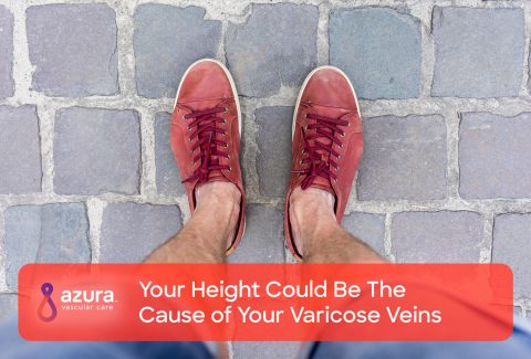 Your Height Could Be The Cause of Your Varicose Veins