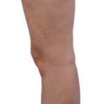 Picture of Leg After Varicose Vein Treatment