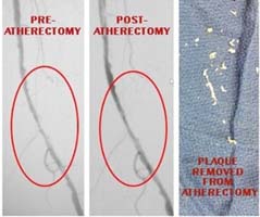 atherectomy_-_edited-image