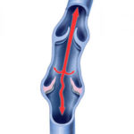 Two-way Valve Bad Blood Flow