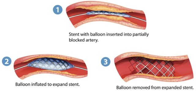balloon-angioplasy-stenting-image